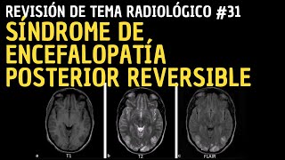 Revisión de Tema 31 Síndrome de Encefalopatía Posterior Reversible PRES [upl. by Bullock]