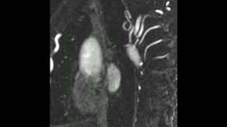 Cardiac MRI  Sagittal series of aortic MRA [upl. by Schofield]