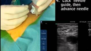 Ultrasound guided arterial femoral access [upl. by Ailadgim]