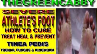 SEVERE ATHLETES FOOT  HOW TO CURE ATHLETES FOOT TREAT HEAL amp PREVENT TINEA PEDIS FUNGUS REMEDY [upl. by Alfi]