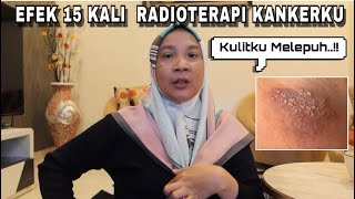 EFEK RADIOTERAPI CANCER KULITKU MELEPUH  JUMPA MAMA MUDA [upl. by Lizette]