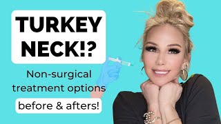 TURKEY NECK How to tighten saggy neck skin tech neck non surgical options [upl. by Batha577]