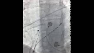 AF ablation with Rhythmia system [upl. by Odlanor]