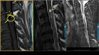 Hemangioblastoma on MRI [upl. by Fionnula955]