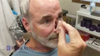 Anatomically Retained Nasal Prosthesis [upl. by Jessen]