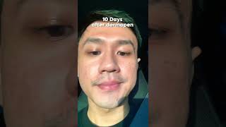 UPDATE AFTER DERMAPEN 15 dermapen dermapenmicroneedling [upl. by Flavian]