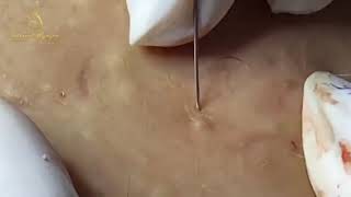 Cysts blackheads and pimples all over the body [upl. by Lilli]