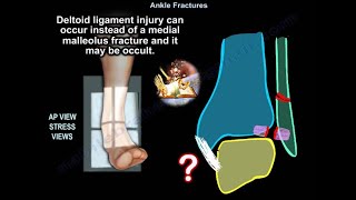 Ankle Fractures  Everything You Need To Know  Dr Nabil Ebraheim [upl. by Ybur80]