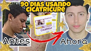 El mejor tratamiento para eliminar CICATRICES de ACNÉ Use CICATRICURE por 90 días y ¡esto pasó [upl. by Hayn]