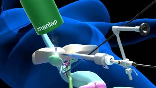 Laparoscopic gallbladder surgery by a single umbilical insicion 3D animation [upl. by Thurmann58]