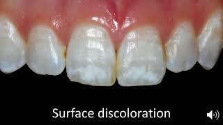 Case Selection for Enamel Microabrasion [upl. by Nedle349]