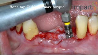 Implant placement for mandibular incisors [upl. by Vasti]