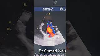 Large ASD Secundum Dilated Rt side😱😲 echocardiogram echocardiography heart cardiology asd [upl. by Olwen306]