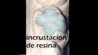 incrustacion dental estetica onlay de resina tecnica indirecta [upl. by Nnylyak381]