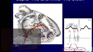 서맥부정맥 2 오용석교수 Bradycardia 2 Prof YS Oh [upl. by Mad]