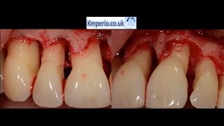 Periodontal Surgery with Regeneration for Upper Teeth [upl. by Lisha]