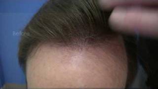 Best Hair Transplants  Dr Wong  7917 Grafts  3 Surgery Sessions [upl. by Leunad]