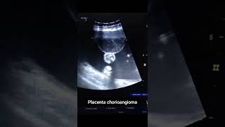 placenta chorioangiomaimaging ultrasound medicalimaging learning medicine viral gynecologist [upl. by Benge]