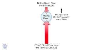 Femoral Cannulation and VenoArterial ECMO  Mayo Clinic [upl. by Bobina]