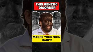 Did you know Unraveling Hypertrichosis Excessive Hair Growth Called as werewolf syndrome [upl. by Oira]