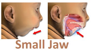 What is the Main Reason of Small Jaw Micrognathia by Prof John Mew [upl. by Fiann]