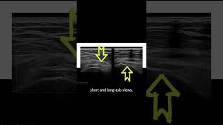 ultrasound Guided Interventions Cases Trochanteric Bursitis Injection [upl. by Hiett109]