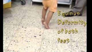 equinus deformity of both feet by Dr Auday Hussain دكتور عدي حسين [upl. by Lyckman]