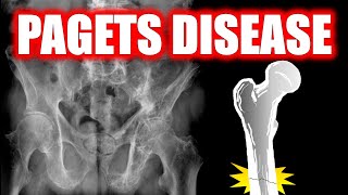 Paget Disease of Bone radiology doctor bones [upl. by Retseh552]