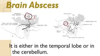 2 Final CSOM and complications narrated 3 [upl. by Hatcher808]