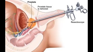 TURP explained and animation [upl. by Aldus327]