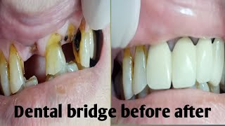 Fix dental bridge before and after [upl. by Ellesirg]