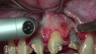 Recession Coverage via Soft Tissue Substitute Frenectomy amp Apicoectomy in Aesthetic Zone III [upl. by Shaner]