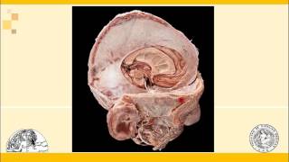 Sistema Nervioso Meninges [upl. by Ammon]