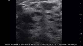 CASE 512 Sonomammography fibrocystic fibroadenosis [upl. by Bonneau]