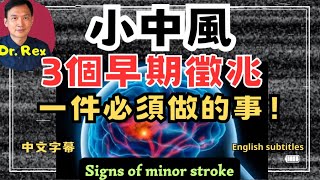 小中風後必定要做的一件事！what is minor stroke and what must be done after an attack [upl. by Zerlina]