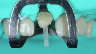 Post Cementation and Core BuildUp Using LuxaCore Z Dual [upl. by Chapman943]