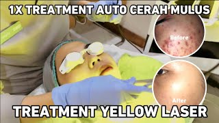 Treatment Yellow Laser di ZAP Surabaya‼️Laser Untuk Mencerahkan Kulit✨ [upl. by Galvan661]