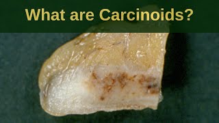 What are Carcinoid Tumours  Pathology mini tutoriaL [upl. by Connors]