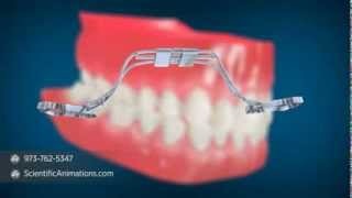 Rapid Palatal Expansion  Dental Implant Procedure [upl. by Rowley]