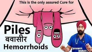 Piles  Hemorrhoids  बवासीर  The Only Cure  DrEducation Hindi  Eng [upl. by Eudo507]