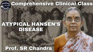 Hansens Disease Leprosy Case presentation [upl. by Lily65]