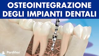 Le osteointegrazione degli impianti dentali © [upl. by Buskus]