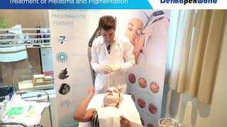 Dermapen 4 Treatment Melasma [upl. by Lethia]