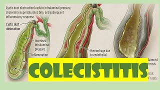 COLECISTITIS ETIOLOGÍA FISIOPATOLOGÍA DIAGNÓSTICO Y TRATAMIENTO [upl. by Persse]