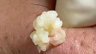 Acne Treatment Huong Da Nang  2024 blackheads 708 [upl. by Iviv]