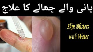 Pani wale dano ka ilaj  skin blisters with water پانی والے چھالے کا علاج [upl. by Ping]