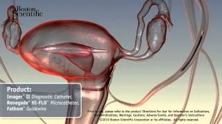 FIS  Uterine Fibroid Embolization UFE [upl. by Light]