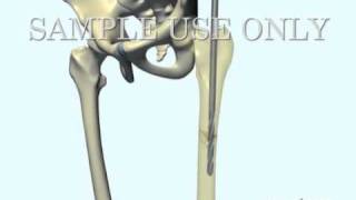 Femoral Fracture Fixation Surgery Intramedullary Nail [upl. by Yrellih356]