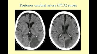 Stroke Syndromes older version with sound  CRASH Medical Review Series [upl. by Nya352]