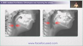 The Case for Biobloc Improving the Airway  William M Hang DDS MSD [upl. by Baird]